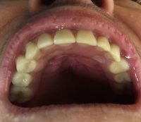 implante-dental-hombre