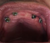 implantes-hombre