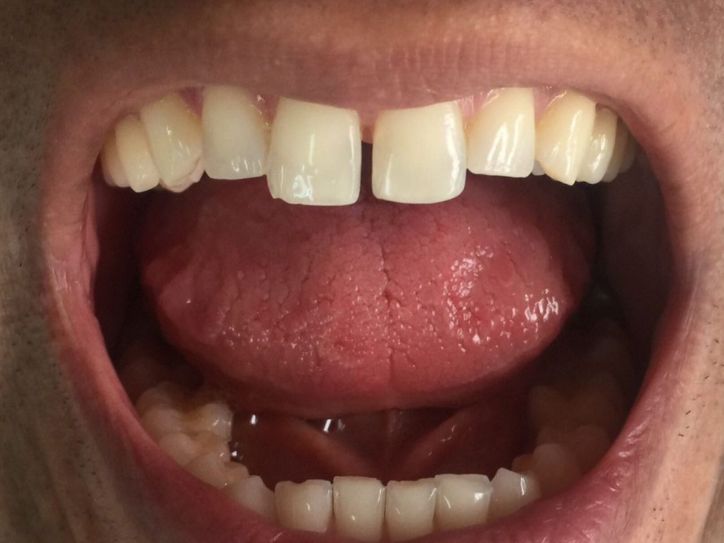 Tratamiento de conductos radiculares para recuperar dientes fracturados, caries profundas o lesionadas en su tejido pulpar