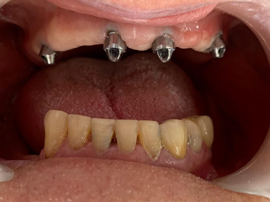 Un implante dental es una pieza de titanio puro que te devuelve la sonrisa que has perdido