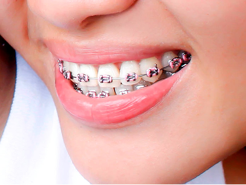 Recuperación perfecta de tus dientes y con ello, tu aspecto dental cambiará favorablemente.